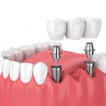 Things You Should Know About Dental Implants 
